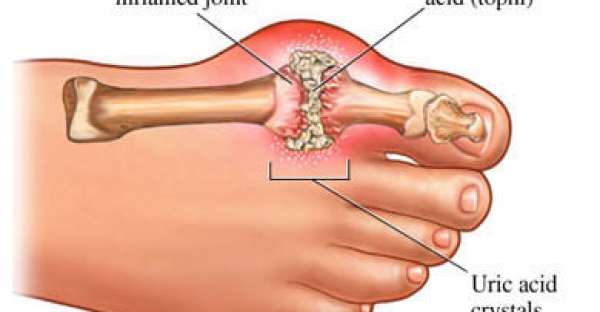 Get Rid of Bunions Naturally With This Simple Powerful Remedy
