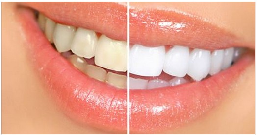 How To Whiten Your Teeth in Just 5 Minutes