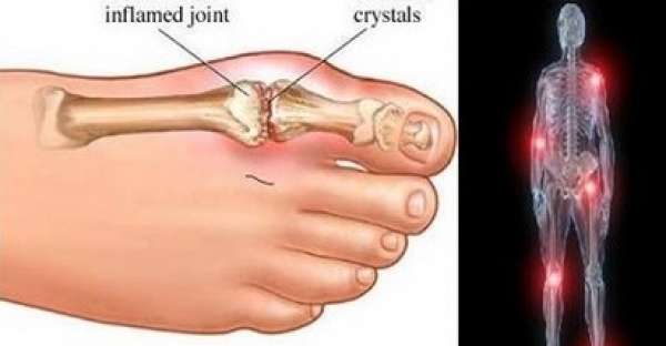 How to Control Uric Acid Levels in 10 Ways