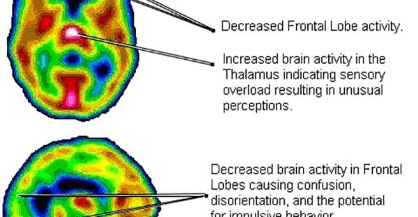 Panic Attacks and Anxiety linked to low vitamin B and Iron levels