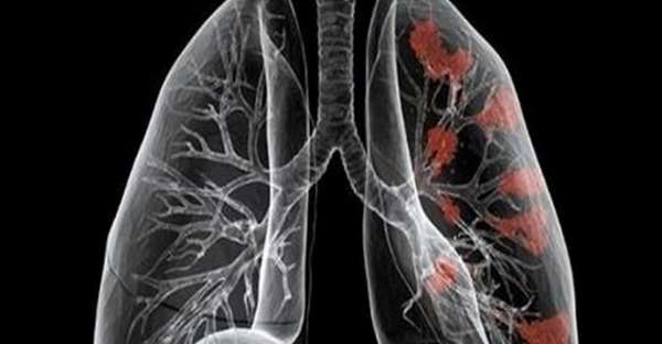 detecting lung cancer